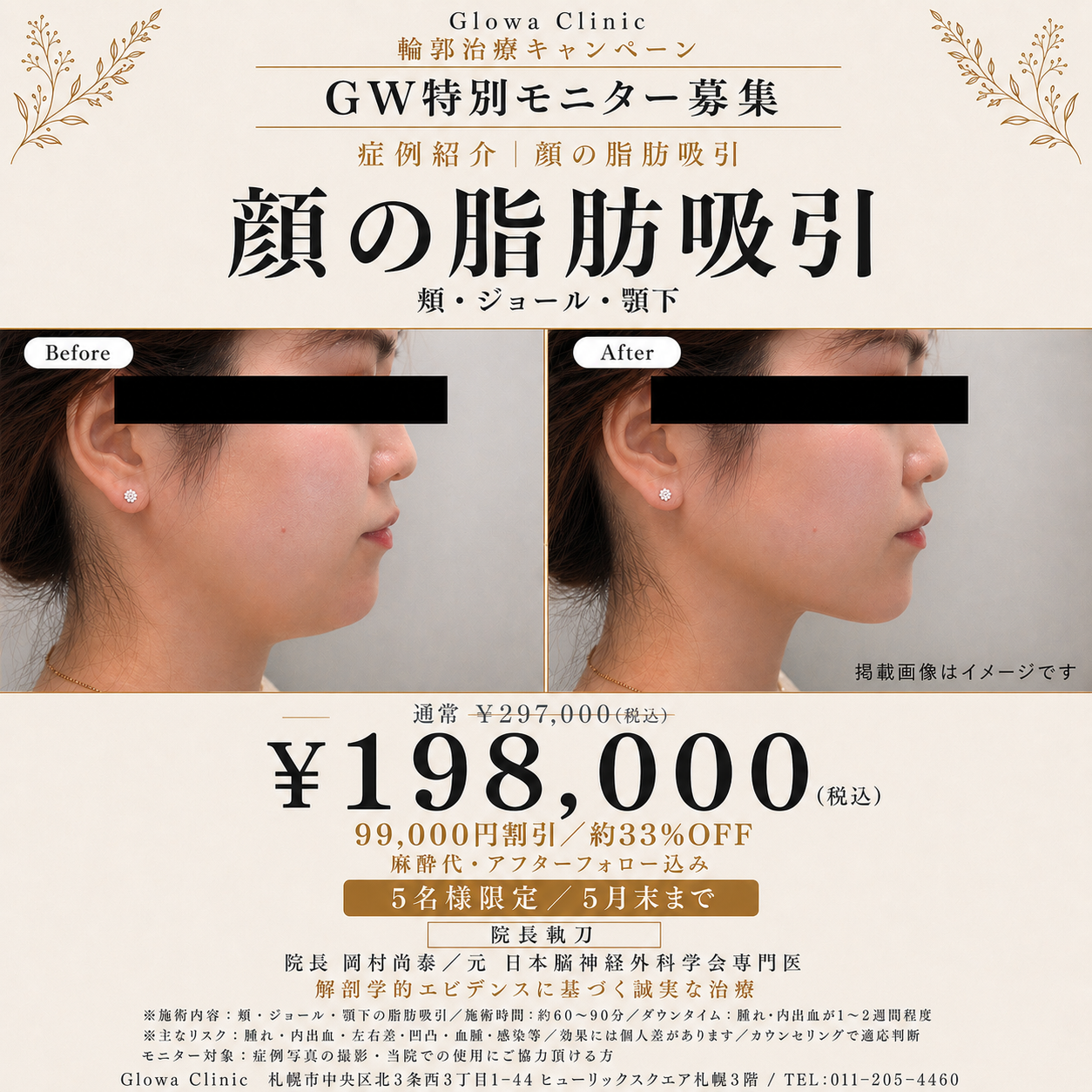顔の脂肪吸引 GW特別モニターキャンペーン