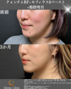 【脂肪吸引だけでいい?】たるみもある方に「クォンタムRF・モフィウス8」を組み合わせる理由を院長が解説