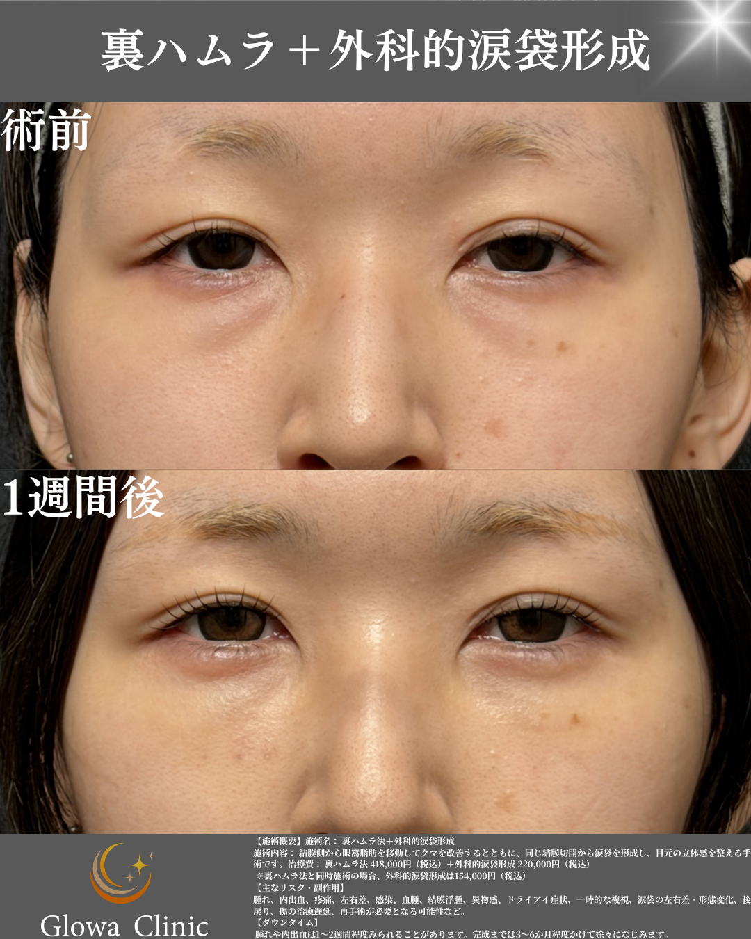 裏ハムラ＋外科的涙袋形成の症例写真（正面・術前と1週間後）