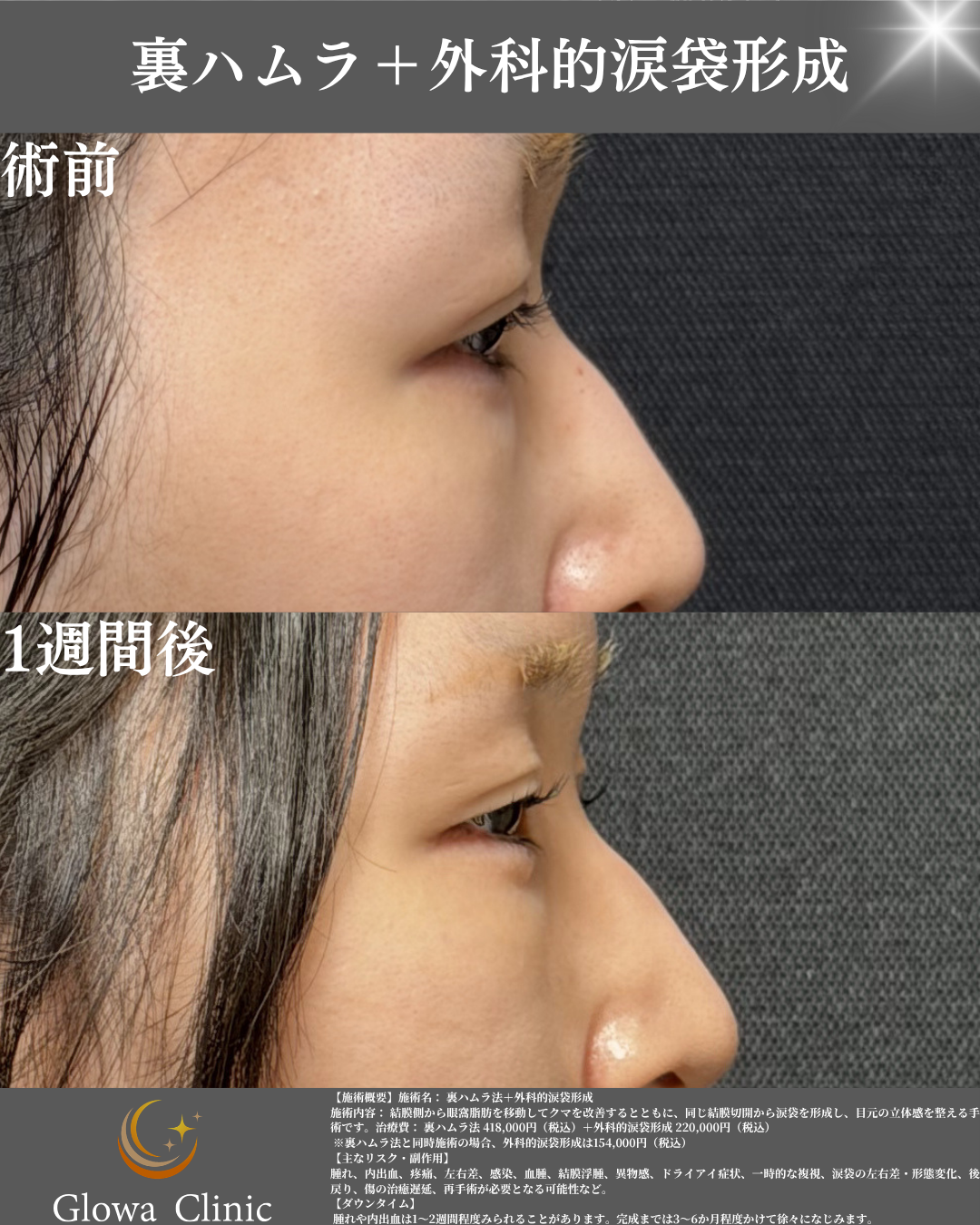 裏ハムラ＋外科的涙袋形成の症例写真（側面・術前と1週間後）