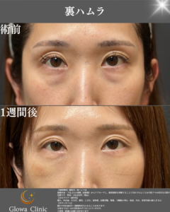 【裏ハムラって何?】目の下のふくらみと窪みを同時に整える手術を院長が解説