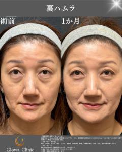 【裏ハムラの正直な話】クマは改善しても“小じわ”が出ることがある？院長が解説