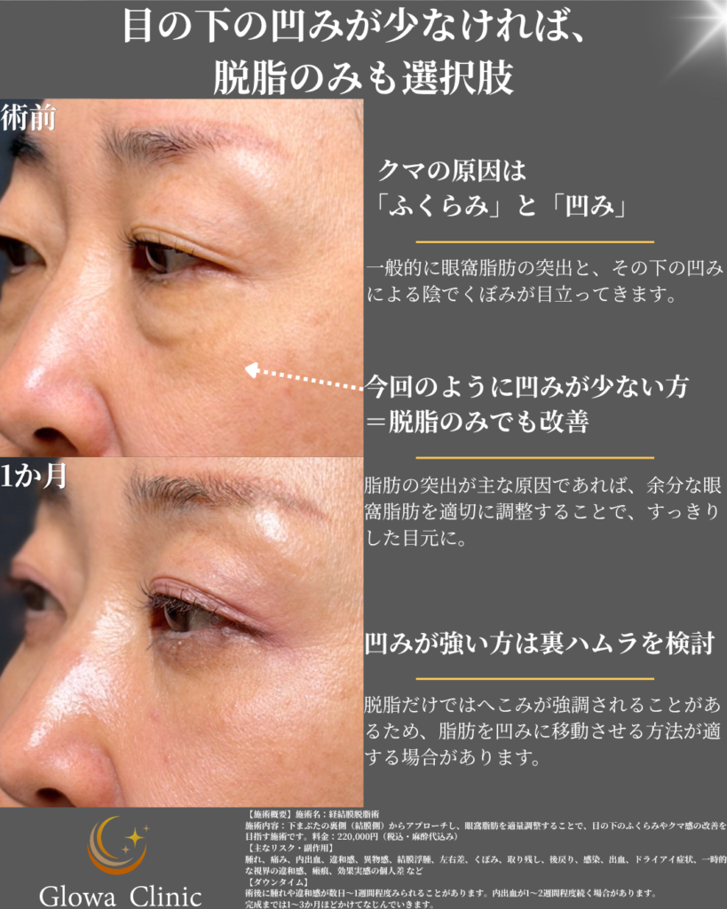 経結膜脱脂術の症例:40代女性の側面(斜位)術前と術後1か月の比較。目の下の凹みが少ない場合は脱脂のみでも改善することを解説した図