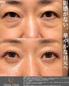 【目の下のクマ】凹みが少なければ「脱脂のみ」も選択肢｜40代の症例を院長が解説