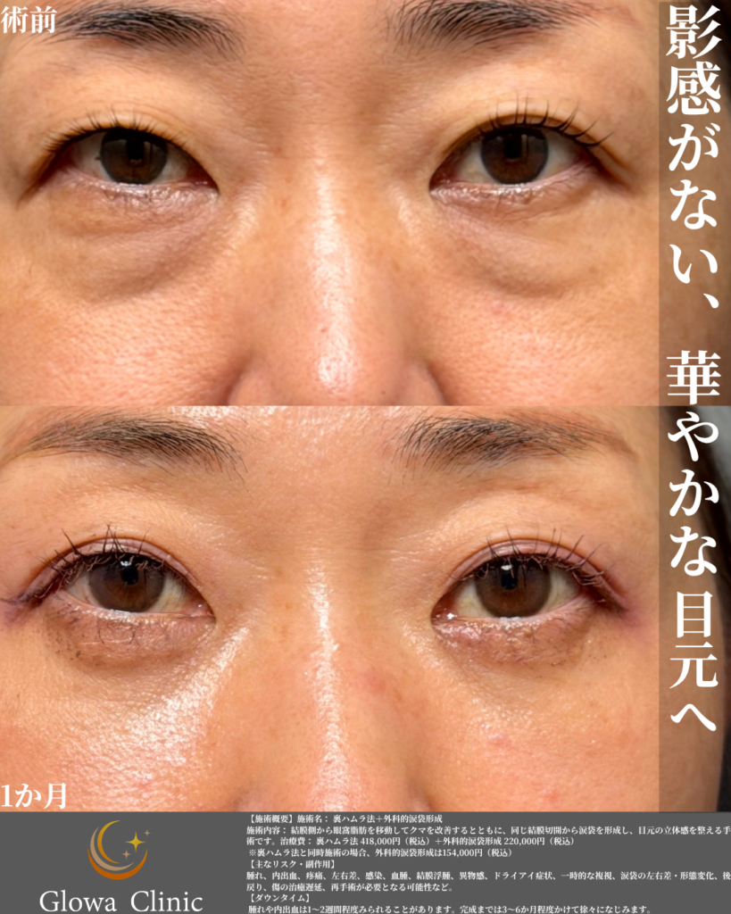 経結膜脱脂術の症例:40代女性の正面 術前と術後1か月の比較。目の下のふくらみとクマ感が改善している