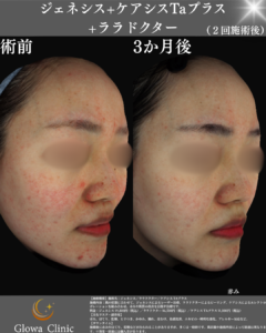 【肌の赤み】そもそも赤みって何？改善のための2つのアプローチを院長が解説