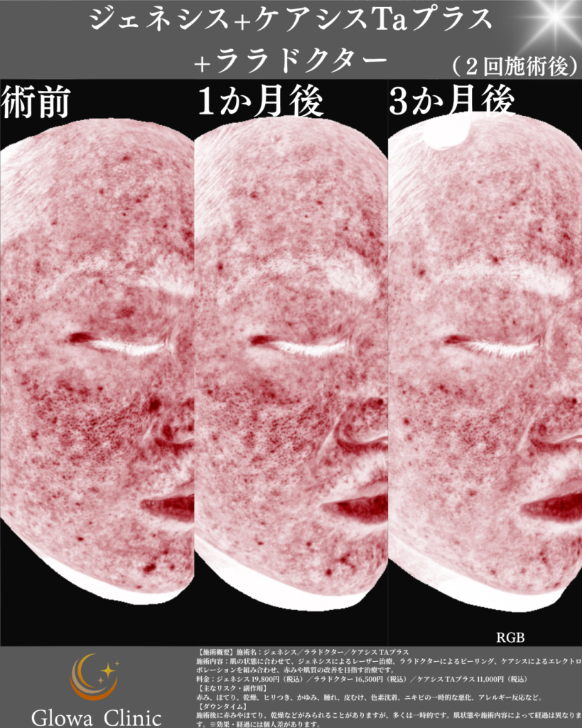 RGB解析による赤みの見える化。術前・1か月後・3か月後
