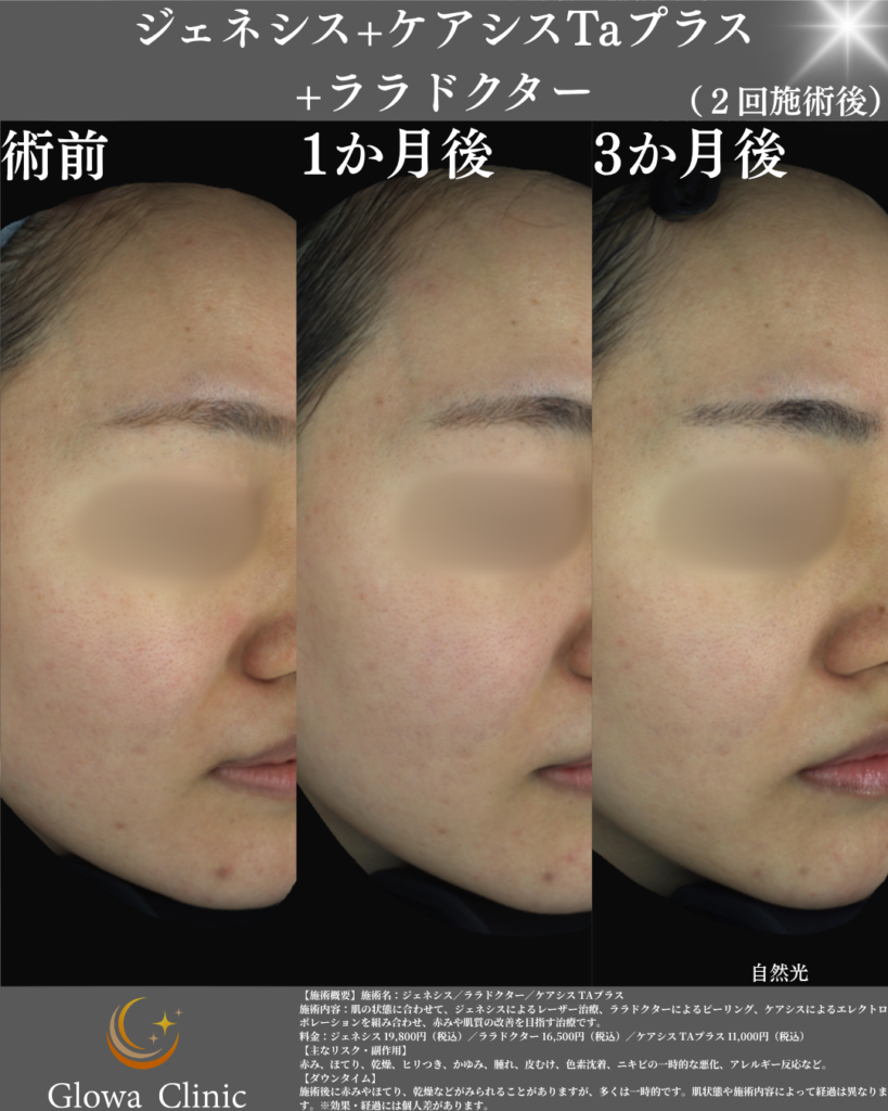 自然光での赤みの見え方の変化。術前・1か月後・3か月後
