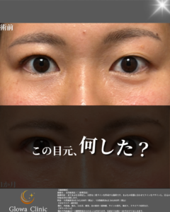 【二重埋没】腫れや傷が不安な方へ｜自然癒着法（4点固定）を院長が解説