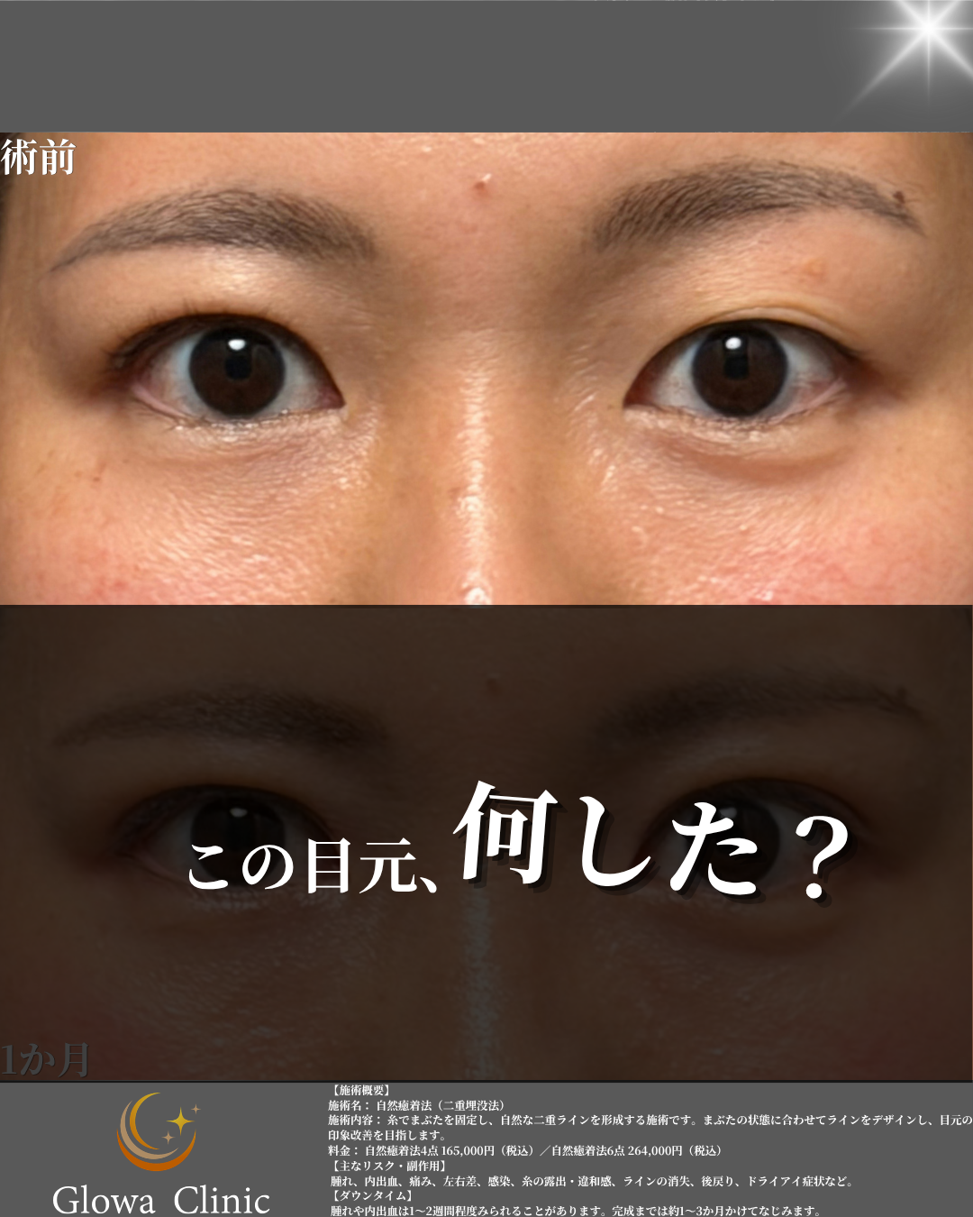 自然癒着法（二重埋没法・4点固定）の術前と1か月後の正面写真