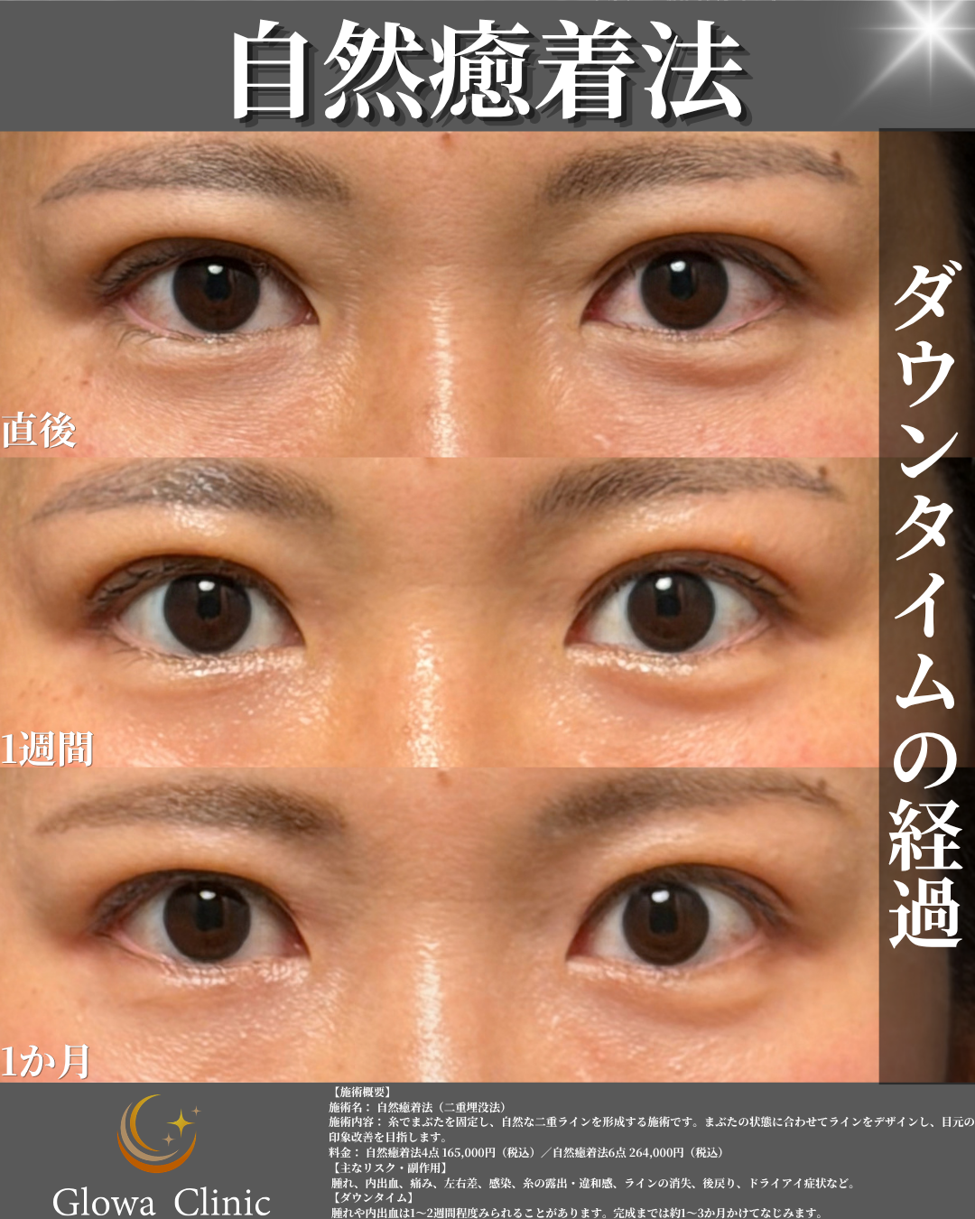 自然癒着法（4点固定）のダウンタイム経過（直後・1週間・1か月）