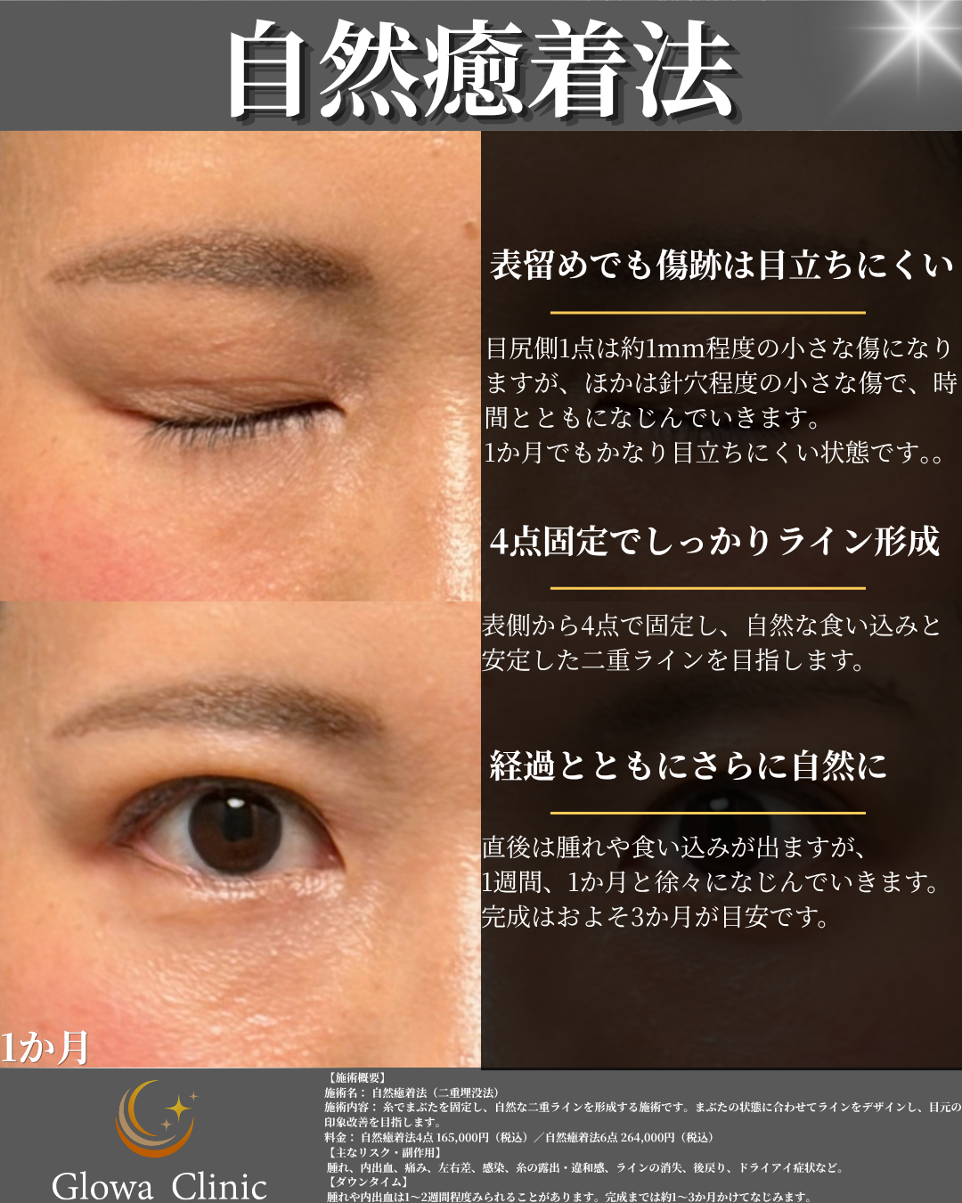 自然癒着法（4点固定）1か月後の閉瞼時と開瞼時の目元