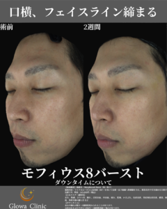 【モフィウス8のダウンタイム】院長が自分で受けて、経過を計時記録してみた