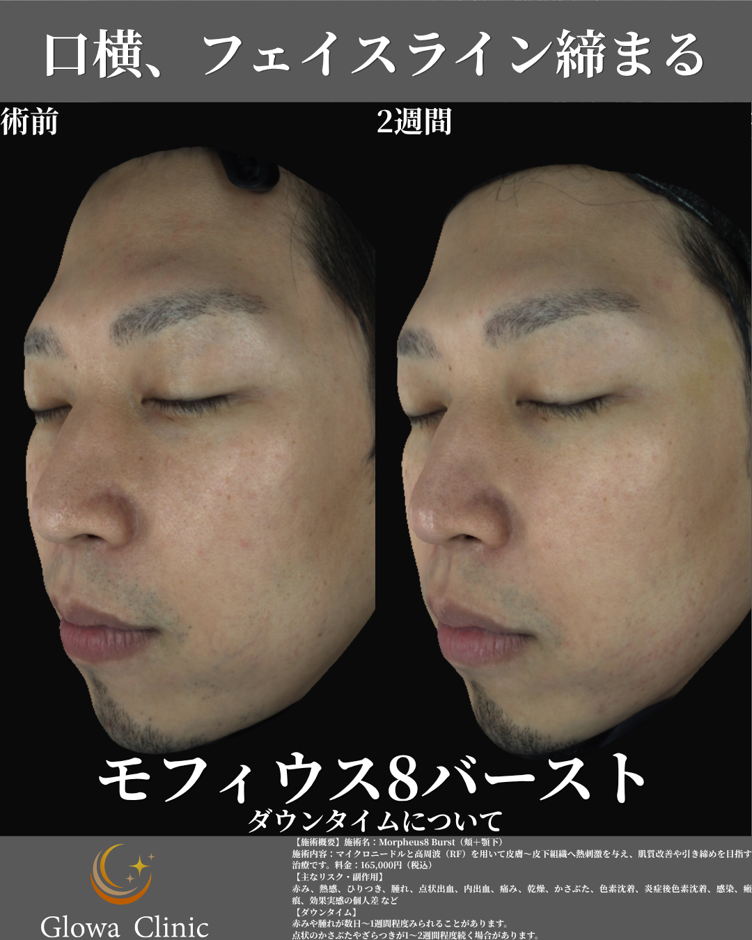 モフィウス8バースト 術前と2週間後の比較