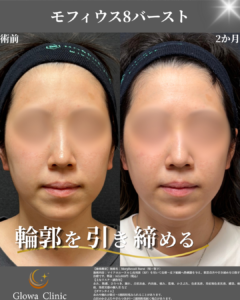 【モフィウス8の症例】脂肪量のある方で変化が分かりやすい一例を院長が解説