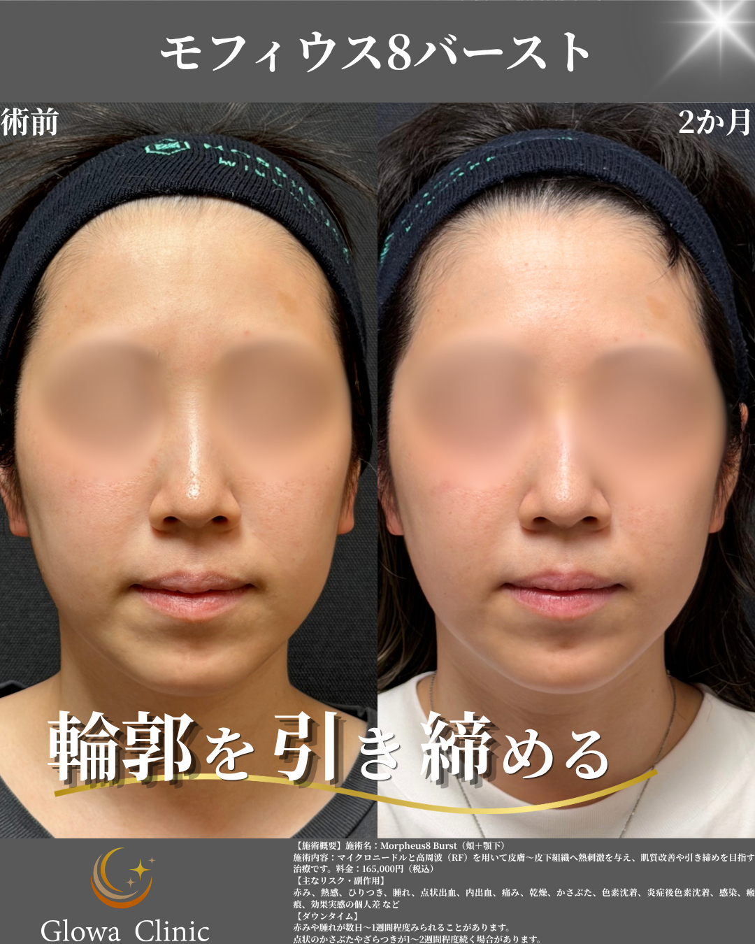 モフィウス8バースト 症例写真（正面・術前／2か月）